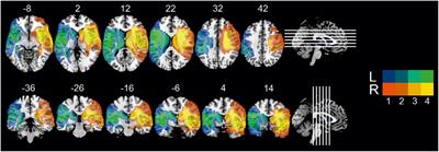 Lateralized Deficits of Disgust Processing After Insula-Basal Ganglia Damage